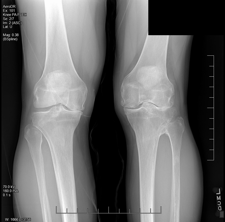 Bilateral knee X-ray showing significant joint space narrowing — bone-on-bone osteoarthritis